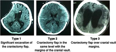 Cranioplasty: A Multidisciplinary Approach